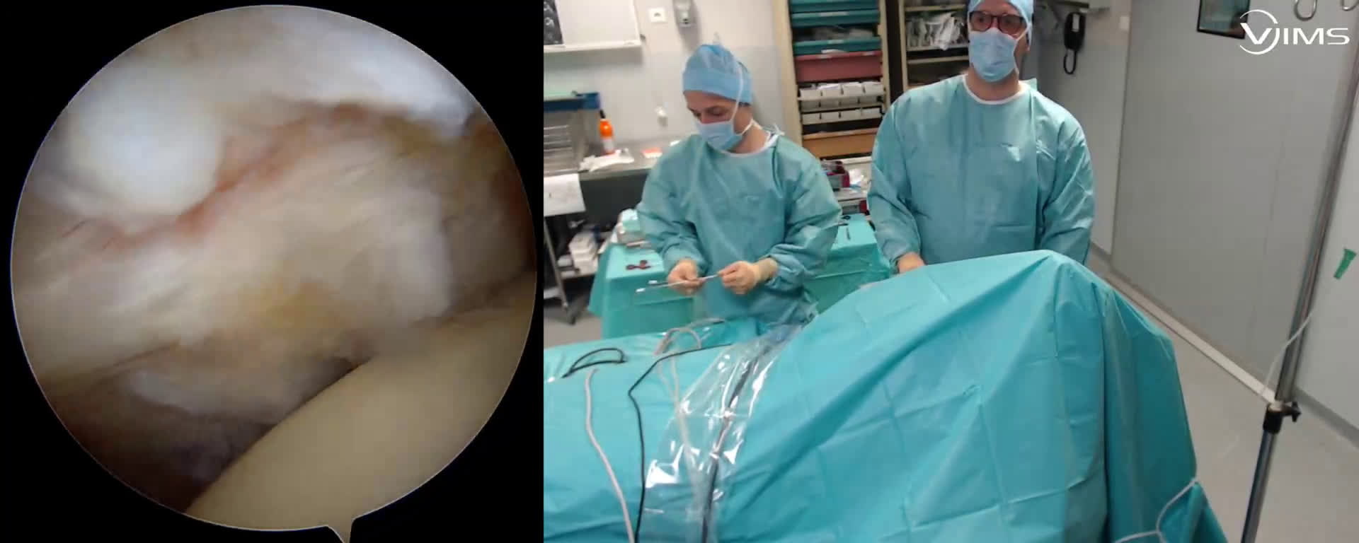 Trillat sur coiffe massive sous arthroscopie ( Guinand)