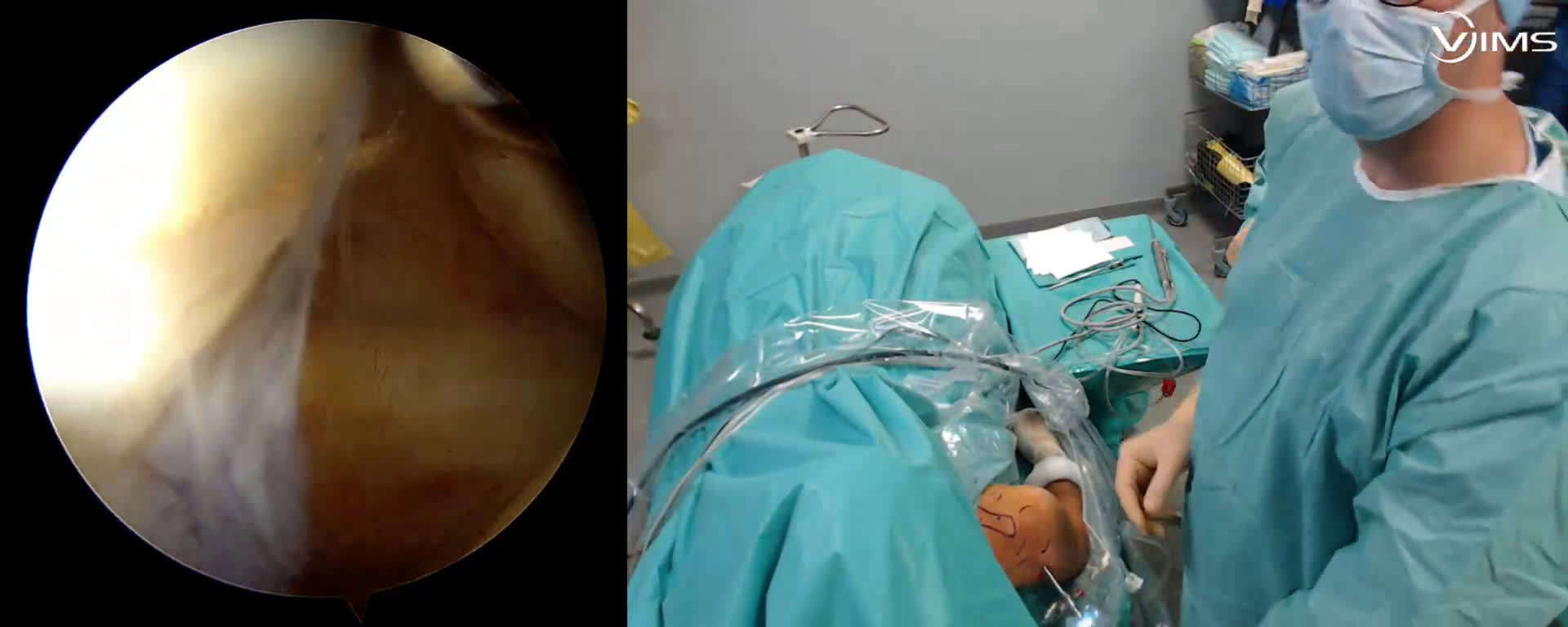 Ligamentoplastie acromio-claviculaire avec double faisceau (implant VIMS) ( Guinand)