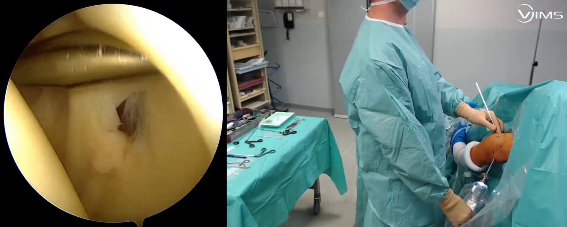 Libération du nerf supra-scapulaire sur kyste synovial sous arthroscopie ( Guinand)