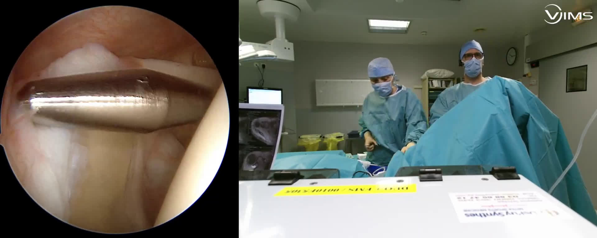 Neurolyse suprascapulaire sur kyste labral postéro-supérieur ( Guinand)