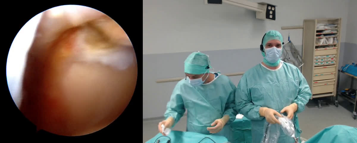 Margin Capsuloplasty ( Guinand)