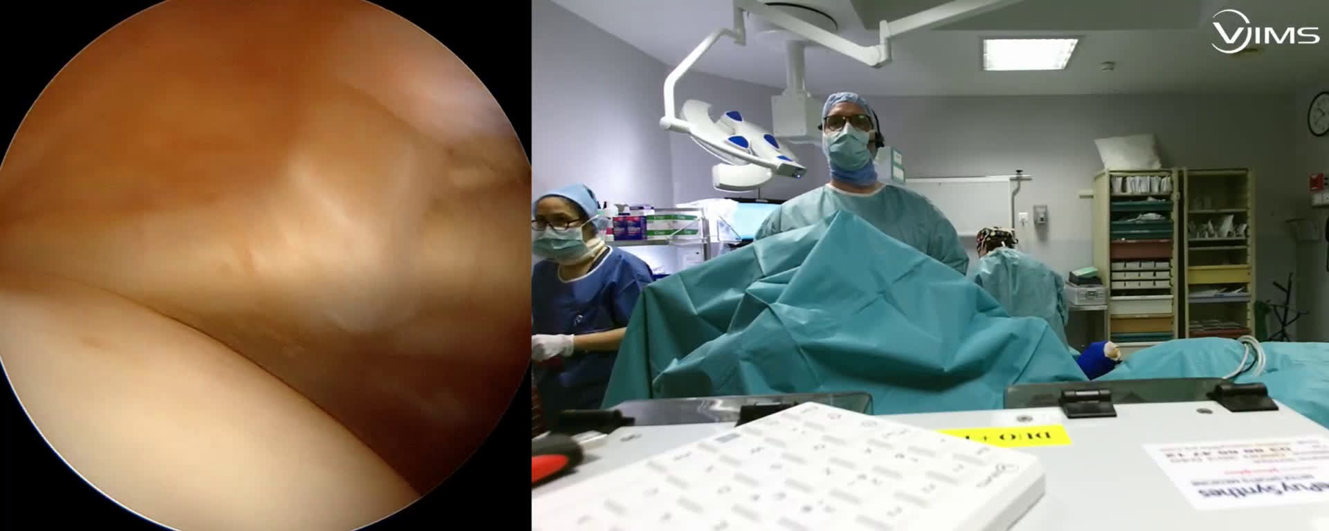 Disjonction acromio-claviculaire ( Guinand)