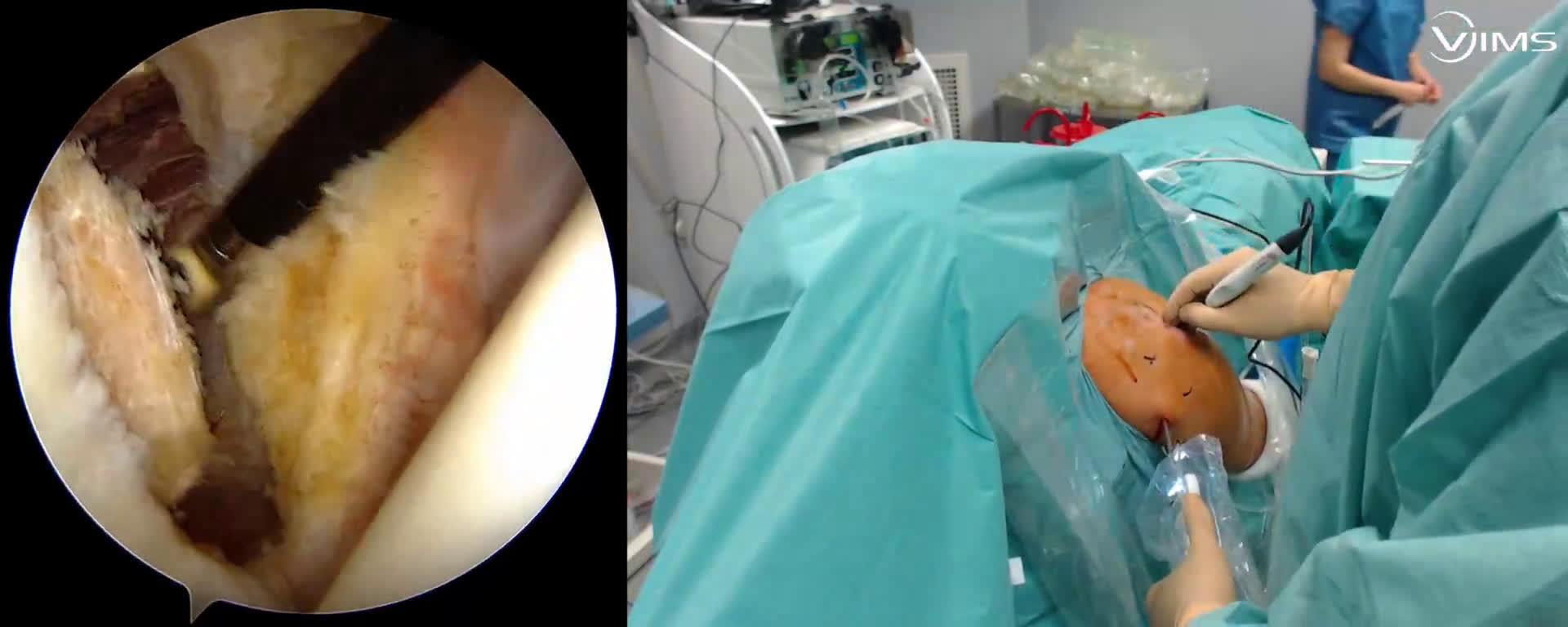 Butée sous arthroscopie avec un nouveau Split ( Guinand)