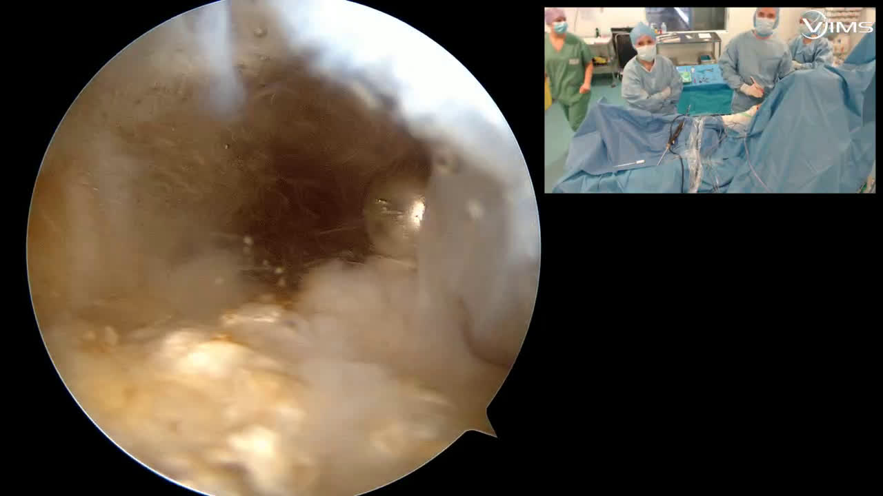 Réparation d'une rupture du supra-épineux type 1, avec Cerise GOSSELIN (Dr. Joudet)