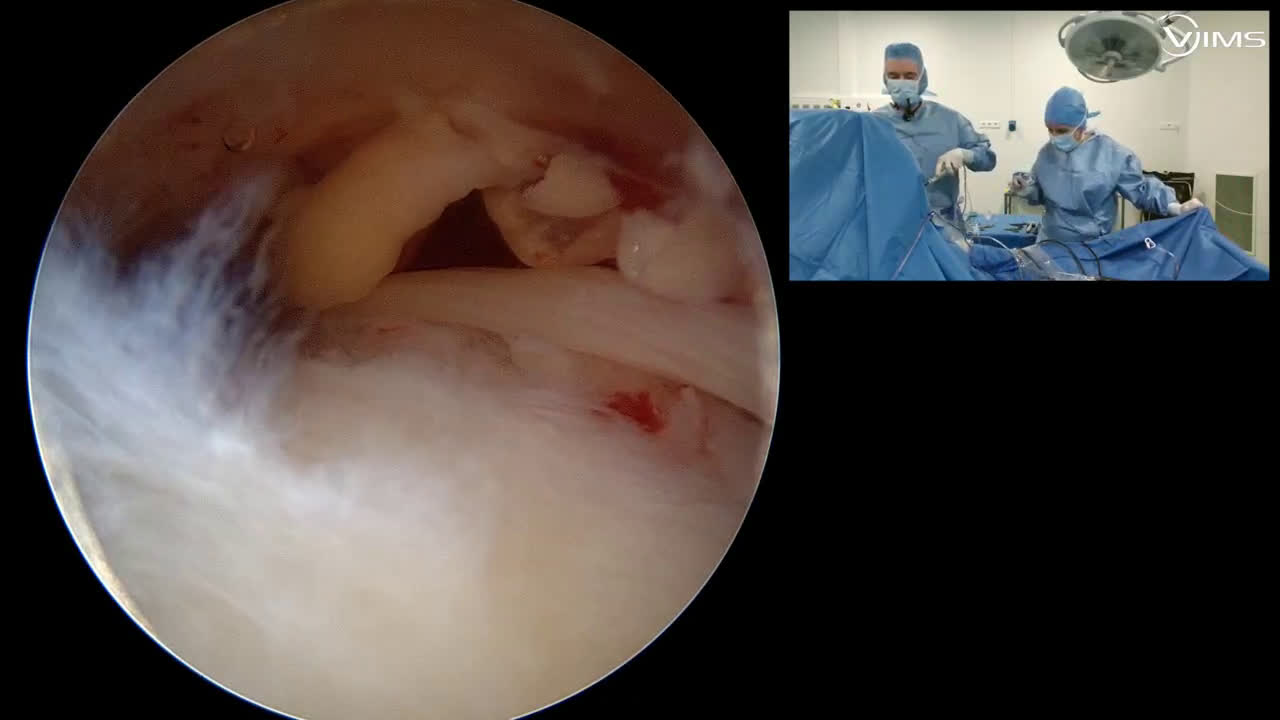 Comment gérer un défaut de cicatrisation d’une suture de coiffe des rotateurs de l’épaule ? (Dr. Joudet)