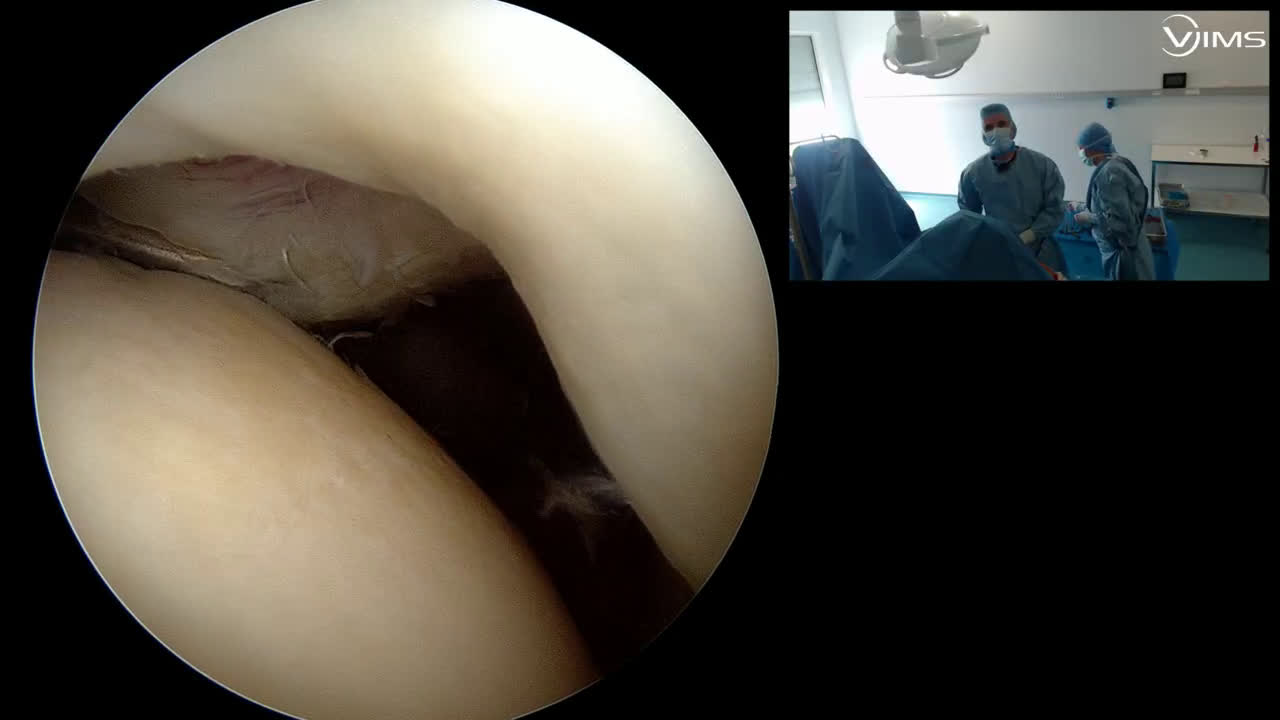 Réparation arthroscopique d’une rupture stade 4 du tendon sous-scapulaire de l’épaule (Dr. Joudet)