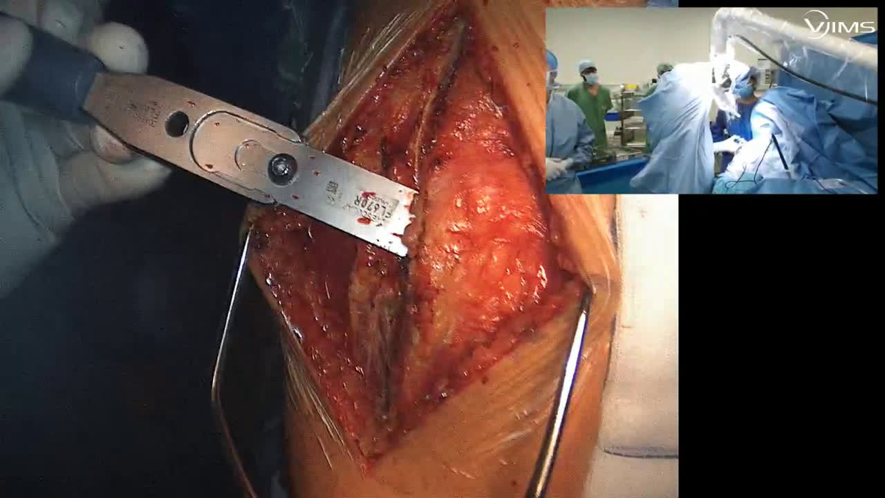 Arthroplastie totale d’épaule anatomique type ISA Stemless Move up par voie latérale (avec le Dr Tania FREITAS) (Dr. Joudet)