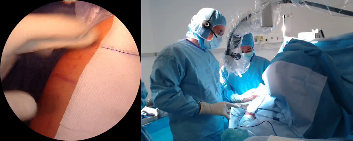 Prothèse totale d’épaule inversée Mathys avec le Dr Angelo du Portugal (Dr. Joudet)