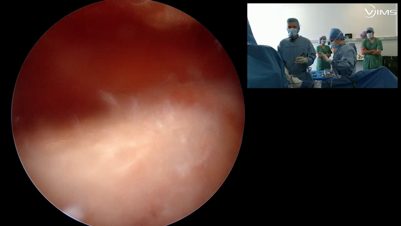 Comment je gère une rupture de la face superficielle du sus-épineux de la coiffe des rotateurs de l’épaule (avec le Dr Tania FREITAS) (Dr. Joudet)