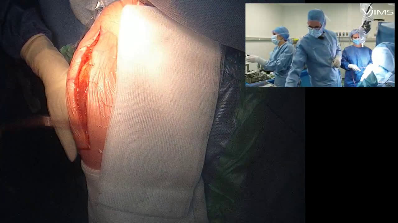 Arthroplastie totale inversée de l’épaule de type ISA inlay cimentée Move up (avec le Dr Tania FREITAS) (Dr. Joudet)