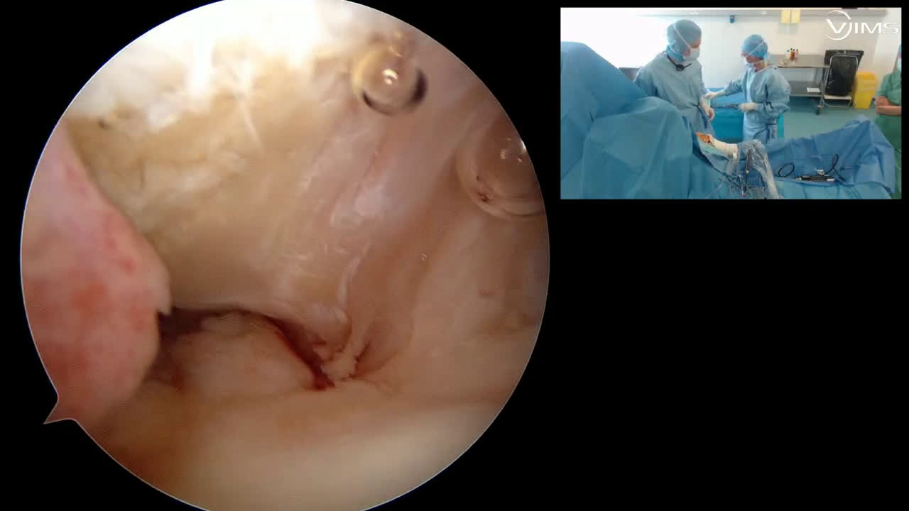 Réparation d’une lésion du sus-épineux isolée de l’épaule sous arthroscopie par double rangée (Dr. Joudet)