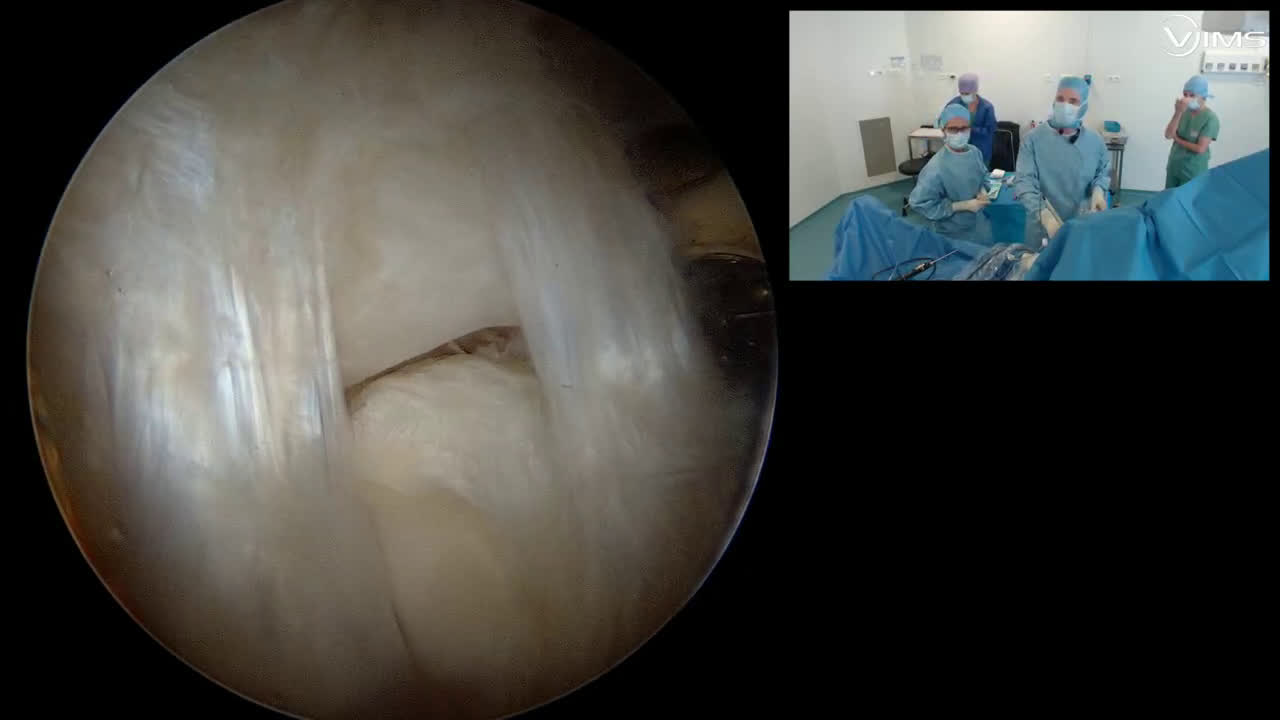 Réparation arthroscopique d'une rupture Ellman 1 du sus-épineux de la coiffe des rotateurs de l'épaule (Dr. Joudet)
