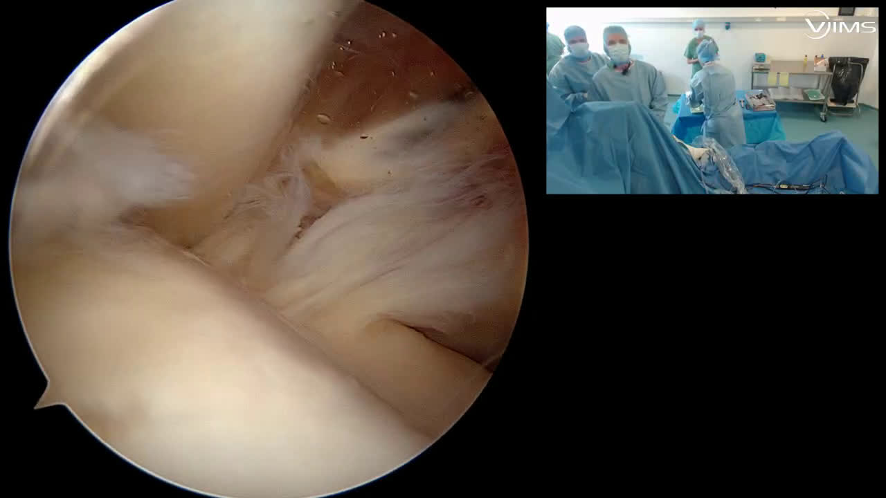Réparation arthroscopique d'une rupture de la coiffe des rotateurs avec ténodèse du biceps à la vis (Dr. Joudet)