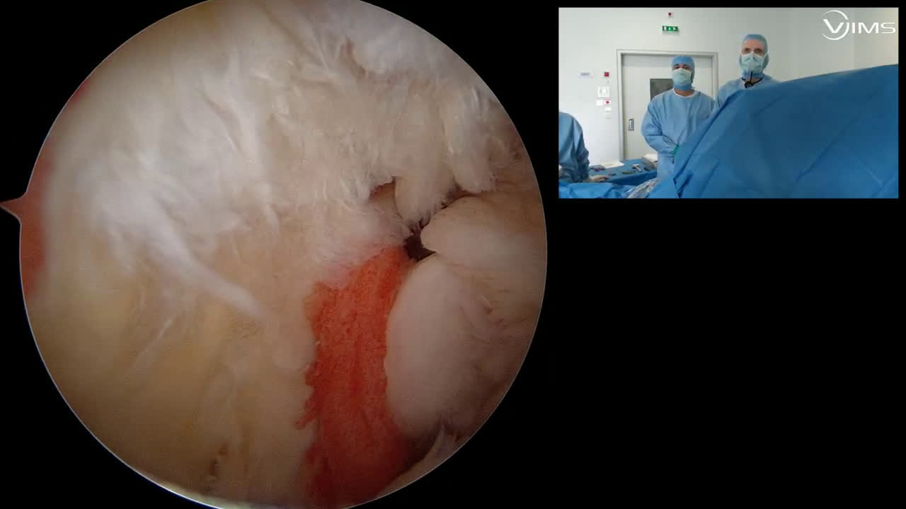 Réparation arthroscopique d'une rupture antéro-latérale en L du supra-épineux de la coiffe des rotateurs de l'épaule (Dr. Joudet)