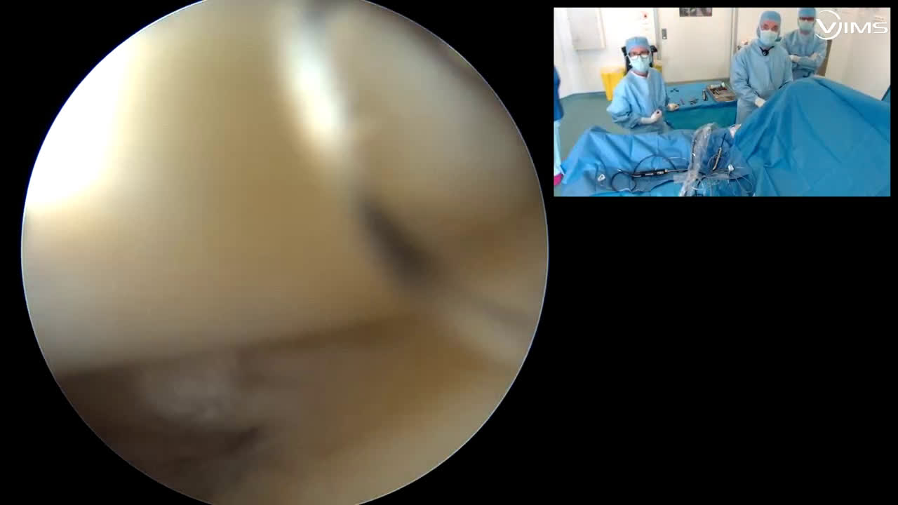 Réparation d’une rupture antérograde supérieure de la coiffe des rotateurs de l’épaule sous arthroscopie (Dr. Joudet)