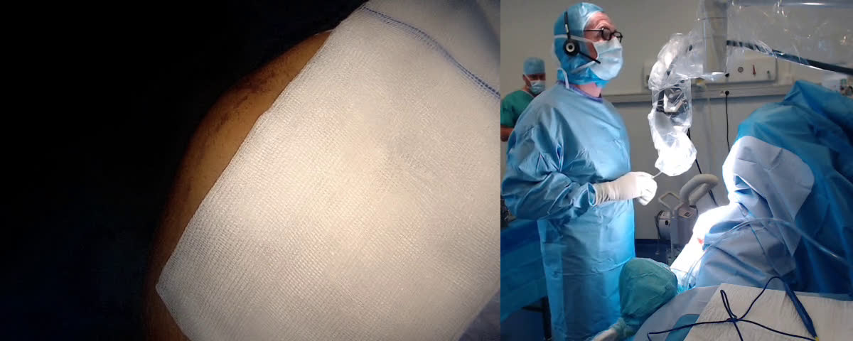 Pourquoi j'utilise une OPENVCAM pour faire une prothèse d'épaule inversée par voie latérale ? (Dr. Joudet)