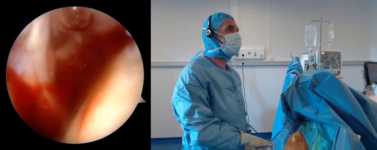 Réparation arthroscopique d’une rupture complète du sous scapulaire avec luxation du biceps (Dr. Joudet)