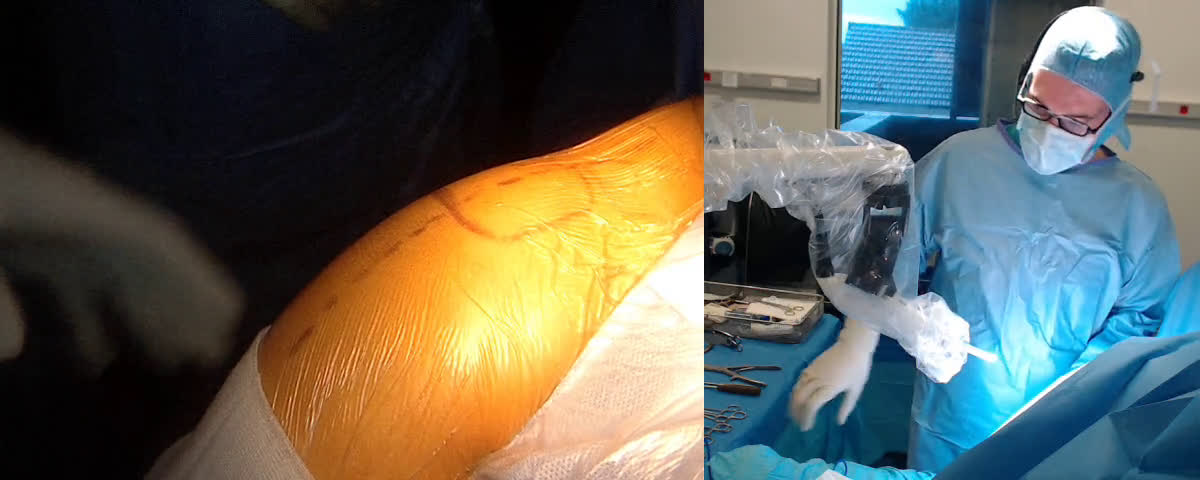 « trucs et astuces » pour poser une prothèse totale d’épaule inversée Mathys par voie latérale (Dr. Joudet)