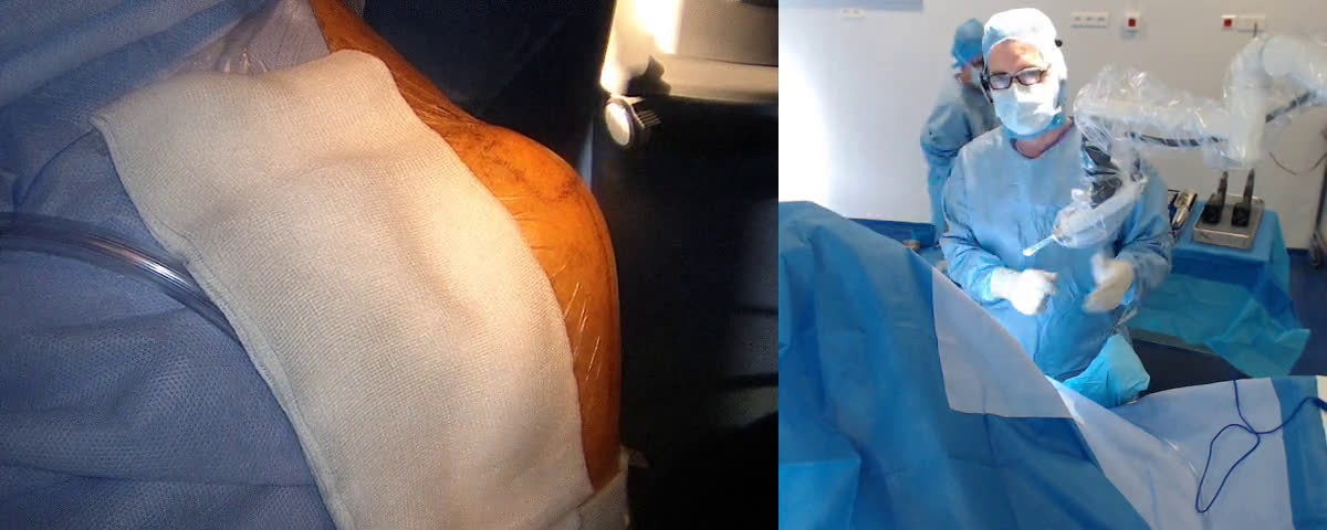« trucs et astuces »  pour poser une prothèse totale d’épaule  Short stem  Mathys par voie latérale (Dr. Joudet)