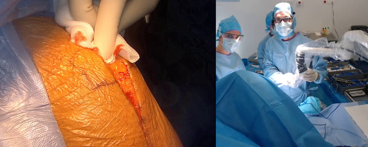 Reconstruction glenoidienne par greffe autologue et pose d’une prothèse inversée Mathys  pour fracture luxation antérieure. avec l’aide du Dr Royaux Déborah (Dr. Joudet)