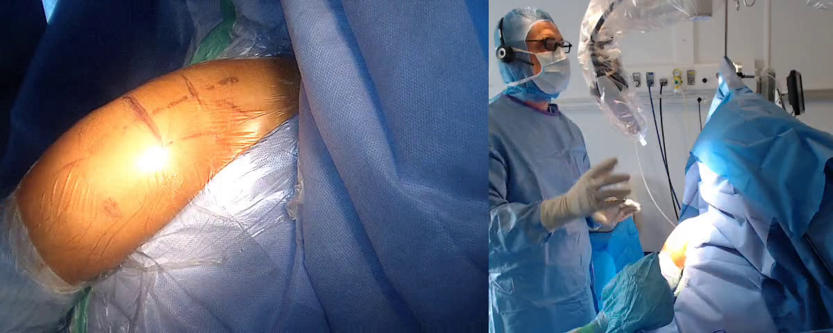 Reverse Shoulder Arthroplasty (Mathys) by Lateral Approach with Dr Danny BIGGS (Sydney, Australia) (Dr. Joudet)