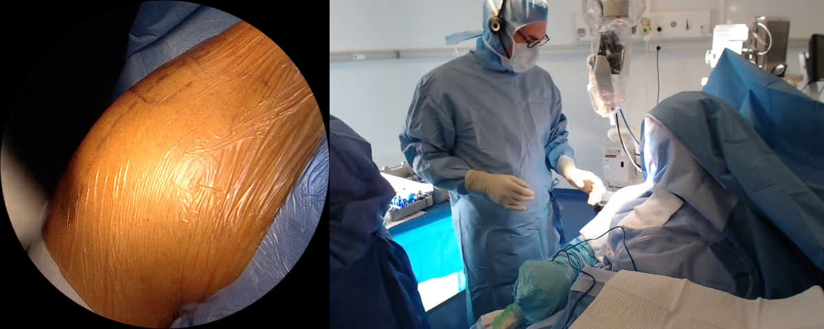 Arthroplastie totale inversée Mathys pour omarthose excentrée par voie latérale (Dr. Joudet)