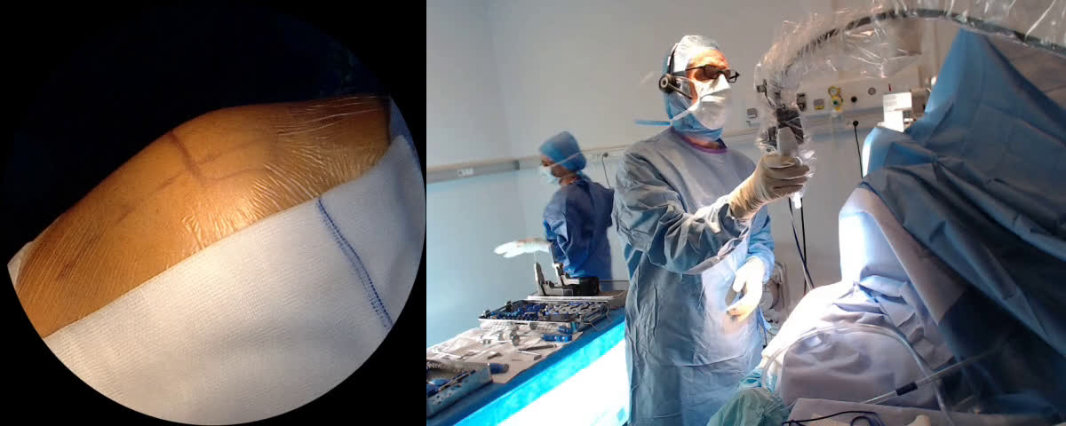 Mathys total stemless anatomical shoulder arthroplasty by lateral approach with Dr Abbas and Dr Lee from London (UK) (Dr. Joudet)