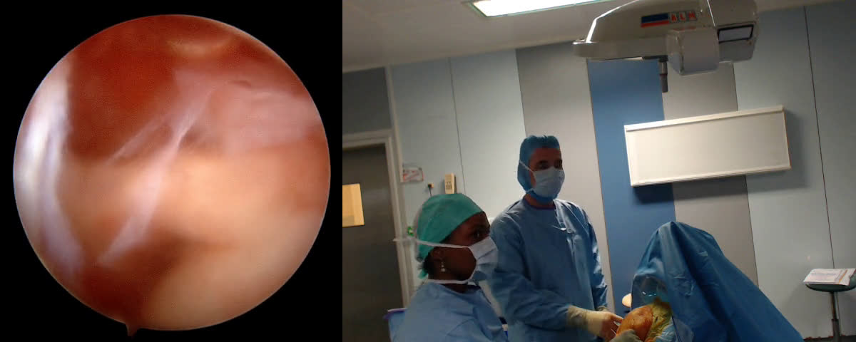 Réparation d’une lésion du supra épineux sous arthroscopie (implant Arthrex et Conmed) (Dr. Joudet)