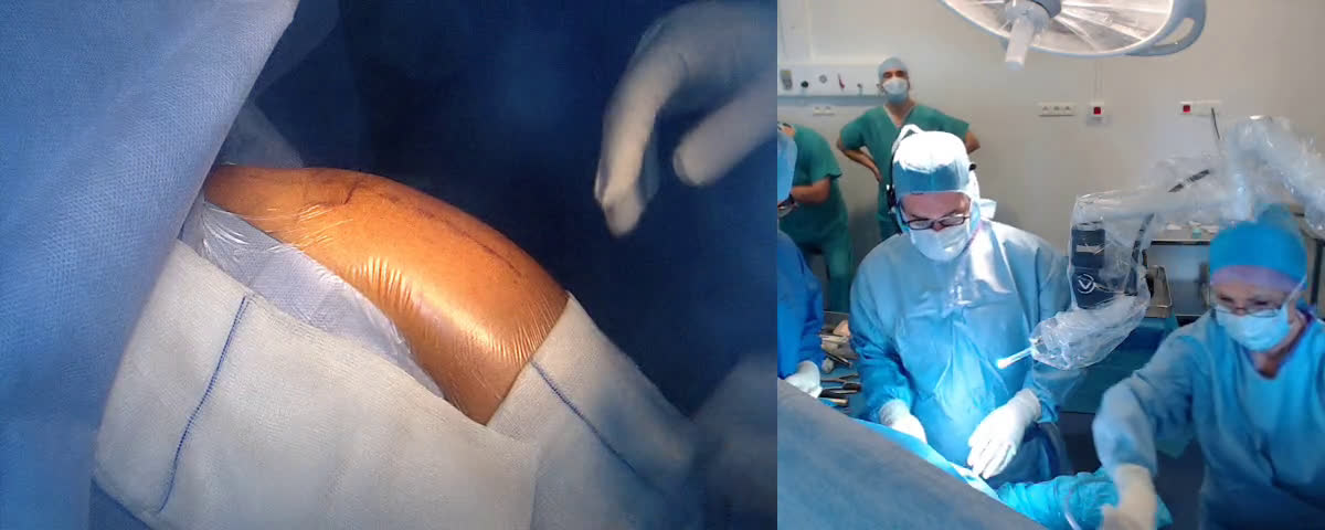 Mathys total reverse shoulder arthroplasty by lateral approach with Dr Abbas and Dr Lee from London (UK) (Dr. Joudet)