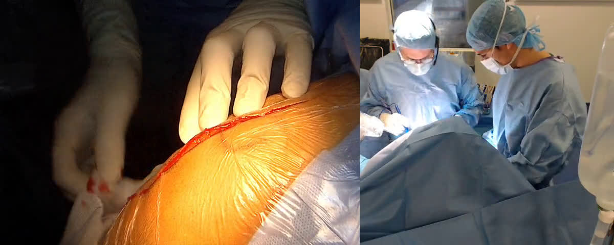 Arthroplastie totale inversée d’épaule par voie delto pectorale avec episcopo modifié (Dr. Joudet)