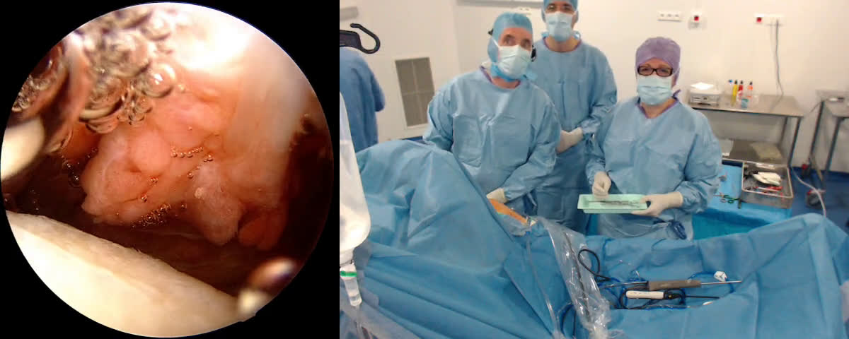 Réparation arthroscopique d’une rupture massive de la coiffe des rotateurs (Dr. Joudet)