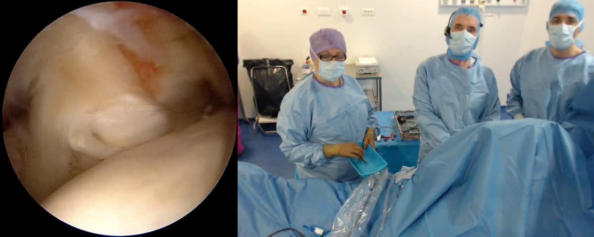 Réparation arthroscopique  d’une rupture complète du sous scapulaire avec coma sign (Dr. Joudet)