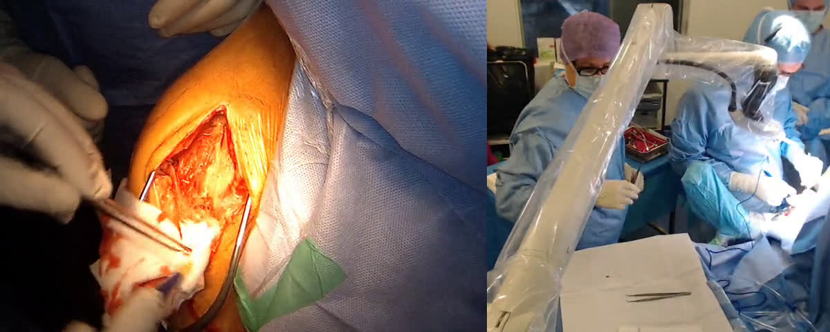 Repose de prothèse totale inversée 8 semaines après une dépose de prothèse inversée dans contexte septique avec le Dr Charles AGOUT (Dr. Joudet)