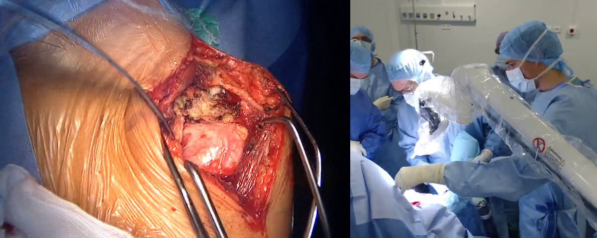 Arthroplastie totale d’épaule anatomique par voie latérale par prothèse sans tige avec le Dr Charles AGOUT (Dr. Joudet)