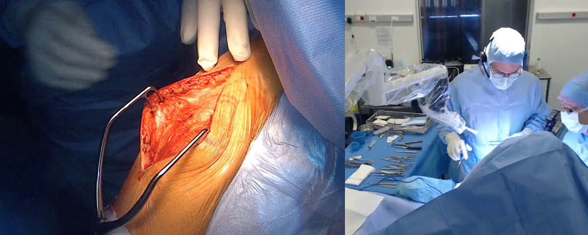 Arthroplastie totale d’épaule anatomique de type stemless par voie latérale (Dr. Joudet)