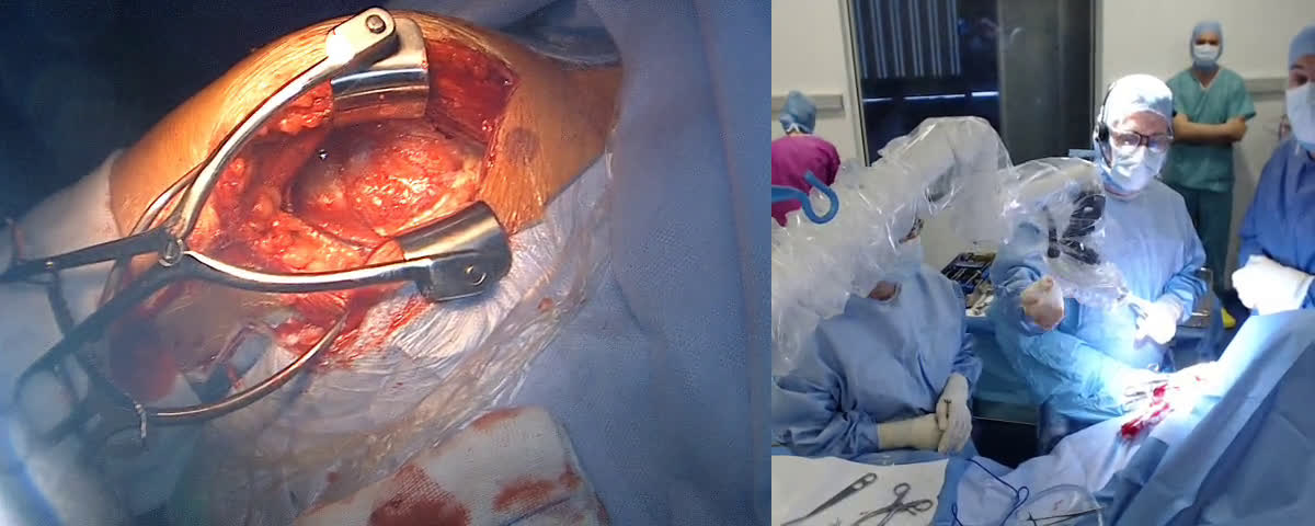 Total reverse shoulder arthroplasty with latissimus dorsi transfert with Dr Viktoras JERMOLAJEVAS (Dr. Joudet)