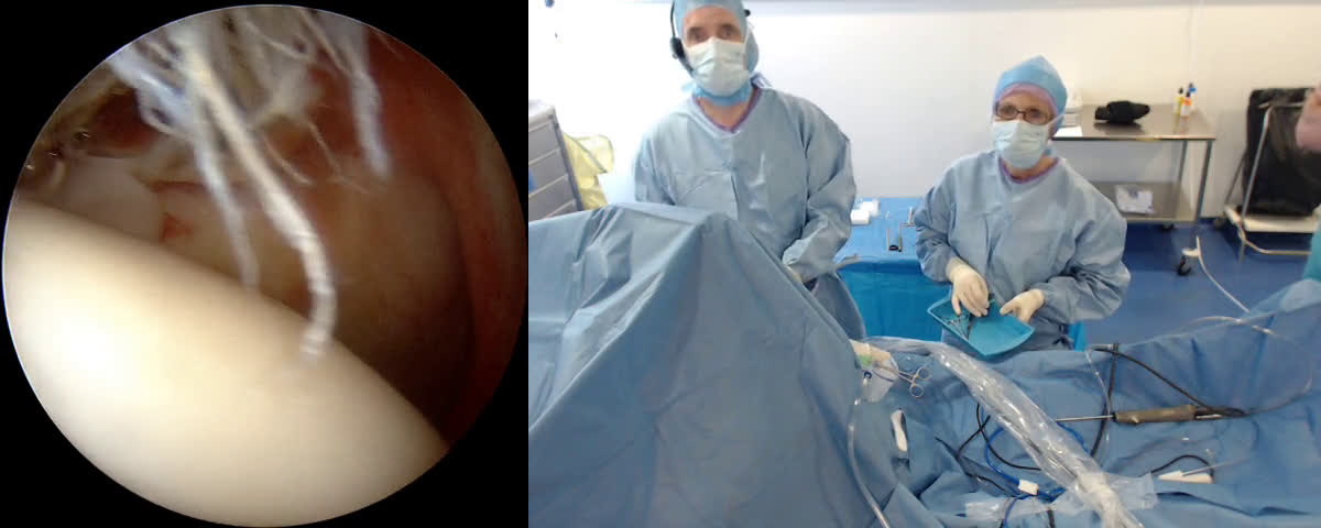 Total reverse shoulder arthroplasty by lateral approach with Dr Viktoras JERMOLAJEVAS (Dr. Joudet)