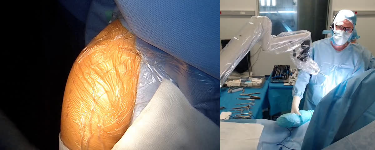 Arthroplastie d’interposition de l’articulation acromio-claviculaire couplée à une prothèse totale d’épaule inversée par voie latérale (Dr. Joudet)