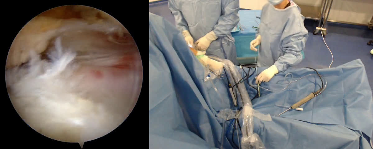 Technique de réparation d’une lésion de la face superficielle du sus épineux en double feuillet (Dr. Joudet)