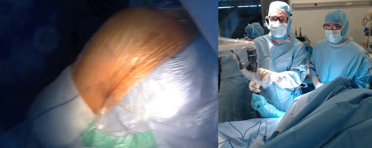 Arthroplastie totale inversée de l’épaule avec transfert du grand pectoral sur une glene type C de 30° avec le Dr Guy AMSALLEM (Dr. Joudet)