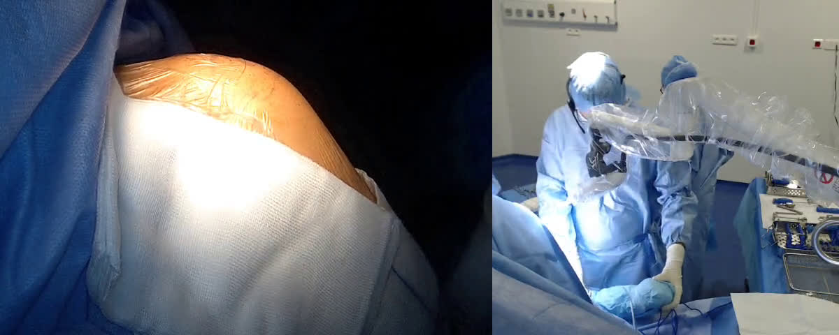 Total stemless anatomical shoulder arthroplasty by lateral approach with  Dr Zeke TAN Australia (Dr. Joudet)