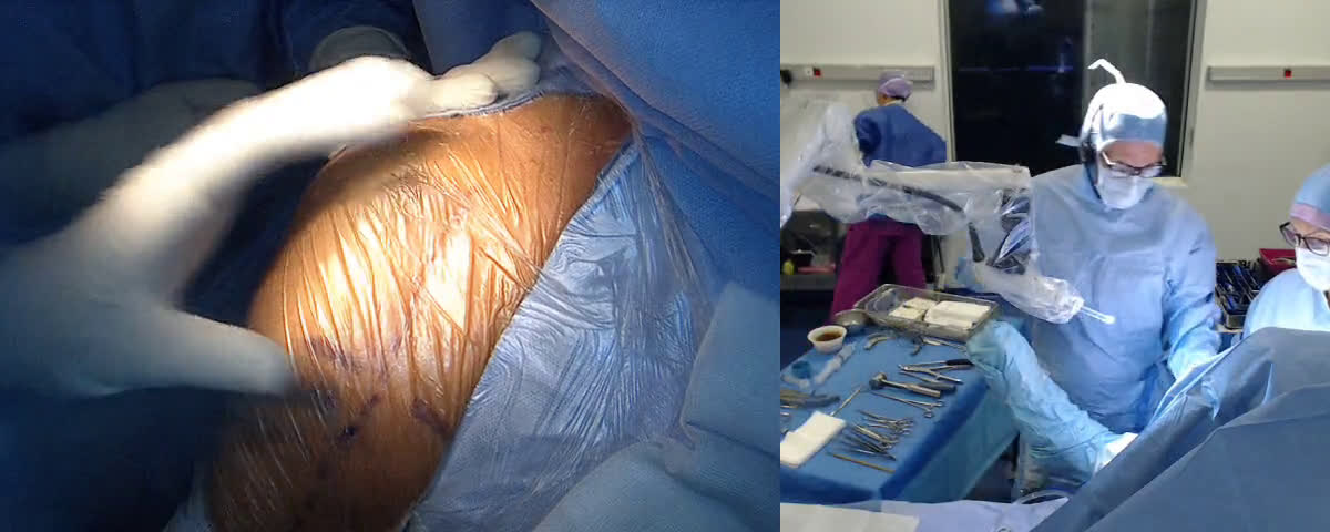 Repose d’une prothèse totale inversée par voie delta pectorale 3 mois après une dépose pour sepsis (Dr. Joudet)