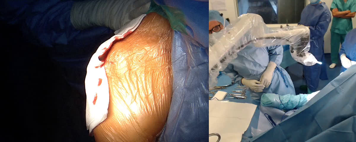 Arthroplastie d’épaule inversée avec une tige conventionnelle et un système onlay (Dr. Joudet)