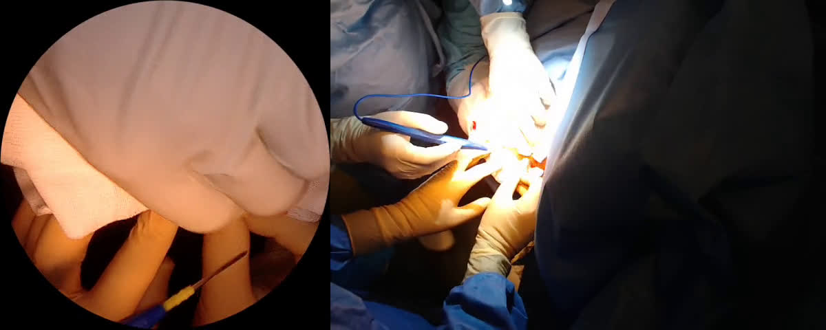 Lateral approach for Stemless Shoulder Arthroplasty with Dr Sameh from Scotland (Dr. Joudet)