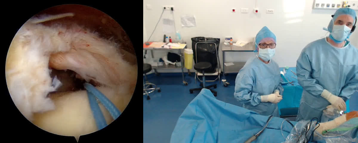 Technique de réparation du « shoelace » sous arthroscopie pour une rupture étendue du supra épineux (Dr. Joudet)