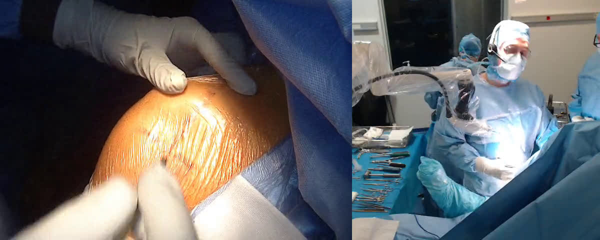 Revision of an anatomical total shoulder arthroplasty by a reverse (With Dr FERNANDEZ UK) (Dr. Joudet)