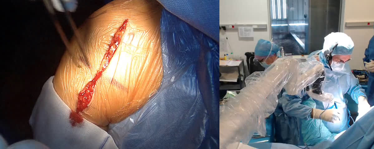 Total reverse shoulder arthroplasty with Lat. dorsi transfert (With Dr FERNANDEZ UK) (Dr. Joudet)
