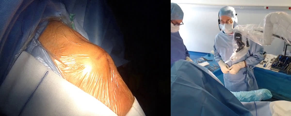 Second stage implantation of a reverse arthroplasty for sepsis (With Dr FERNANDEZ UK) (Dr. Joudet)