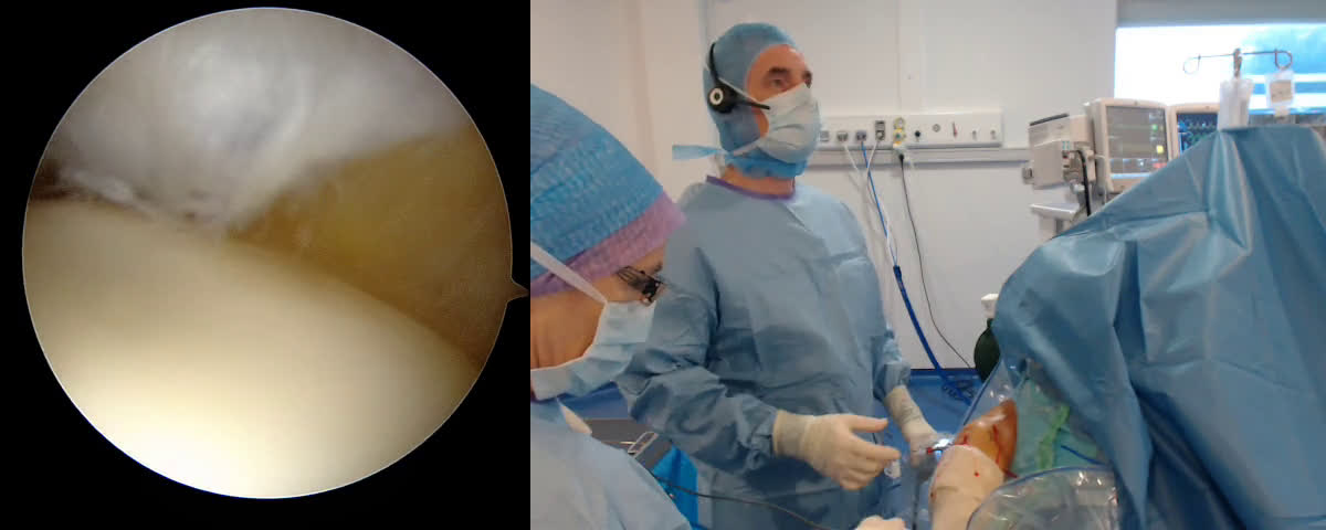 Isolated Sub Scapularis tear with a Biceps luxation (Dr. Joudet)