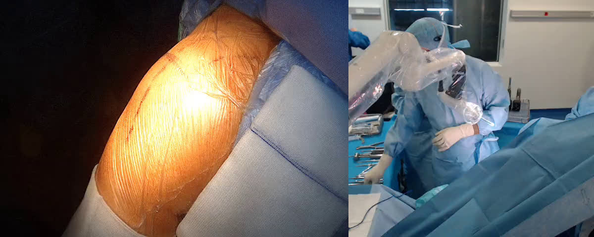 Reverse total shoulder arthroplasty by lateral approach with Dr Kunle Arogundade from Melbourne Australia (Dr. Joudet)